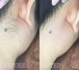 大切なイベント前に綺麗な背中へ！花嫁さんに人気の背中ッワクス。