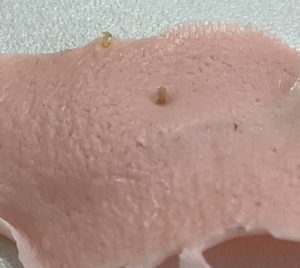 夏までにつるつるぴかぴか背中に仕上げませんか？！